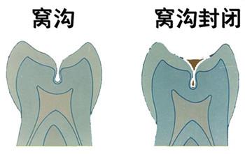 孩子幾歲做窩溝封閉能有效預(yù)防齲齒？