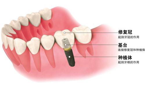 深圳牙種植價(jià)格一般是多少？