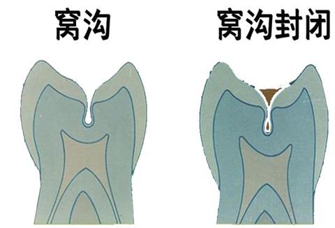 什么是窩溝封閉？