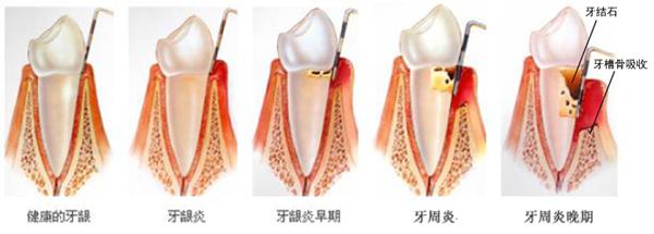 怎么治療牙齦炎？