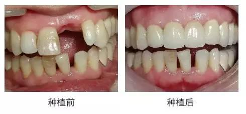 深圳一顆種植牙需要多少錢？