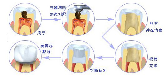 根管治療收費標(biāo)準(zhǔn)是怎樣的？