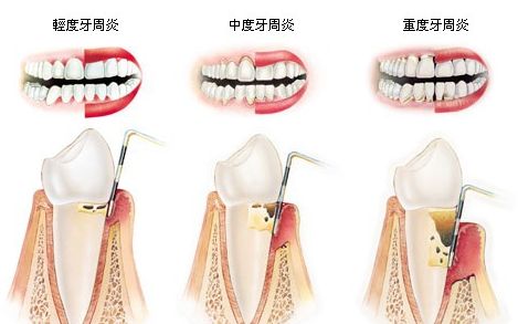 牙周炎癥狀怎么治療？