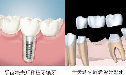 鑲固定牙需要多少錢？