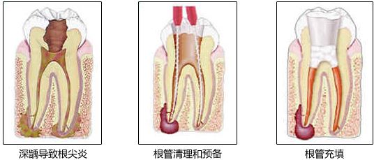 深圳牙齒根管治療費(fèi)用是多少？