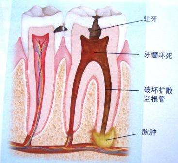 深圳牙齒根管治療費(fèi)用是多少？