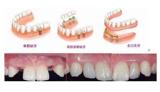 牙齒沒了怎么修復比較好？