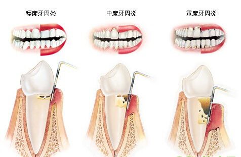 嚴(yán)重的牙周炎怎么辦？