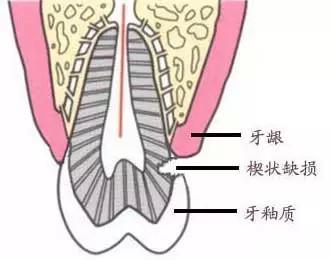 牙齒楔狀缺損怎么辦？