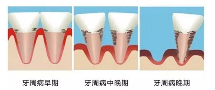 牙周炎是怎么回事？