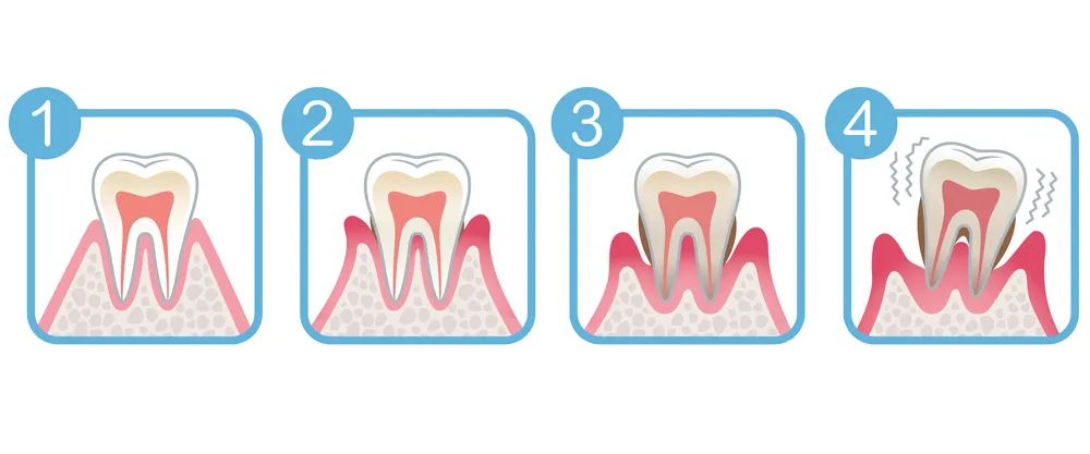 為什么會得牙周炎？深圳愛康健口腔牙周治療優(yōu)惠價限時搶?。?！